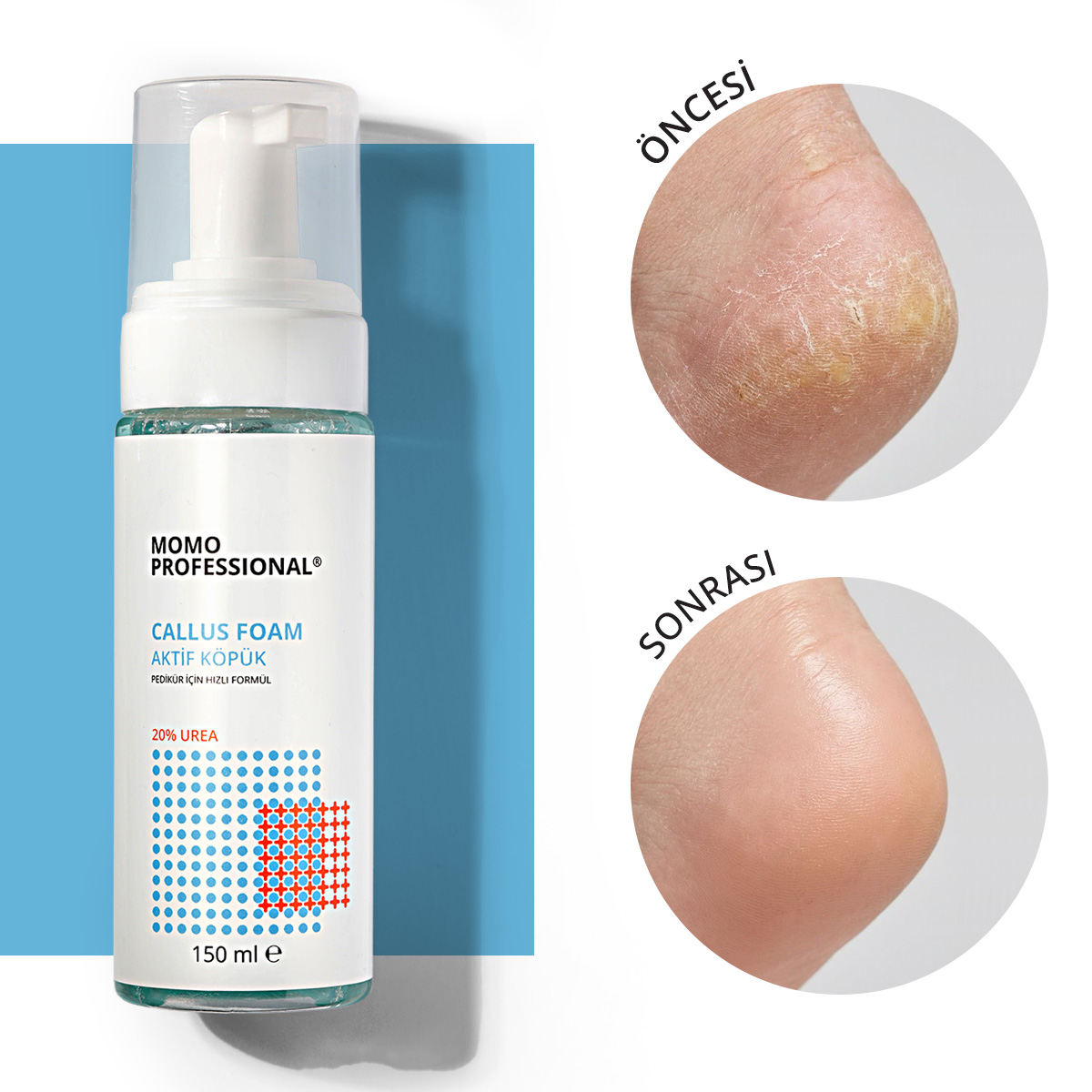 CallusFoam-kare.jpg Callus Foam, Nasır Sökücü Köpük, Pedikür için Keratolitik, 150 ml - Görsel 1