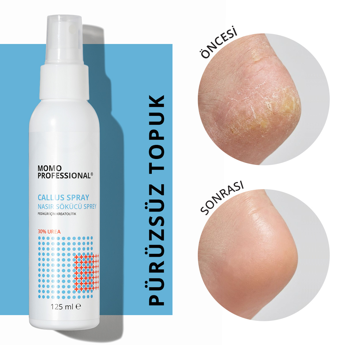 CallusSpray01-2.jpg Callus Sprey, Nasır Sökücü Sprey, Pedikür için Keratolitik , 125 ml - Görsel 1